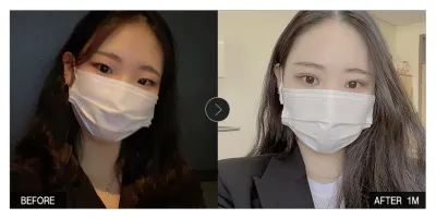 [Review Gangnam Unni] Một tháng sau phẫu thuật mắt / Biệt danh: Naenun-ini-nun