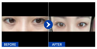 [Babitalk] Nhấn mí tự nhiên / Tuần 2 / Biệt danh: Yungbak