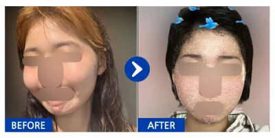 [Babytalk] Phẫu thuật gọt mặt / 1 tháng / Biệt danh: 이이으루루루