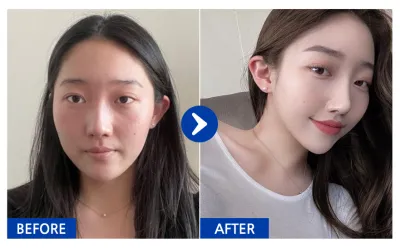 [Babytalk] Phẫu thuật mũi (Mũi chức năng + Mũi thẩm mỹ) / Tháng thứ 2 / Biệt danh: atmospe