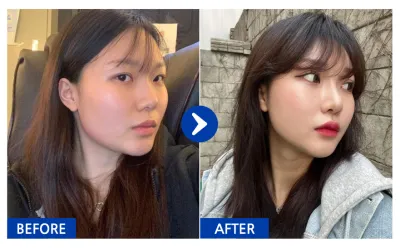 [Babitalk] Phẫu thuật mũi / Tháng thứ 10 / Biệt danh: Seolyun2