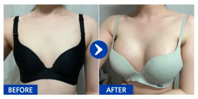 [Babitalk] Phẫu thuật ngực / Tháng thứ 1 / Biệt danh: 24