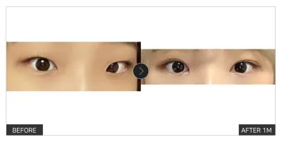 [Review Gangnam Unni] Phẫu thuật thẩm mỹ mắt sau một tháng / Biệt danh: meyh_h