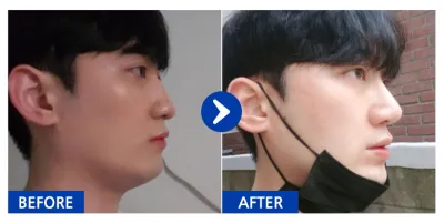 [Gangnam Unni] Phẫu thuật mũi / Tháng thứ 6 / Biệt danh: Haek-gyu