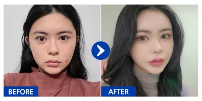 [Gangnam Unni] Cấy mỡ / Tháng thứ 5 / Biệt danh: ooaa.a