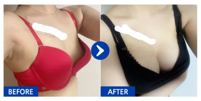 [Babitalk] Nâng ngực / Tháng thứ 8 / Biệt danh: Mel-lyong