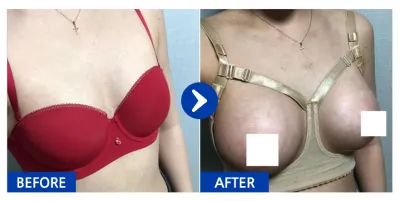 [Babytalk] Phẫu thuật nâng ngực / Tuần 2 / Biệt danh: Amy Unnie