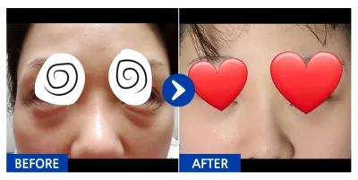 [Gangnam Unni] Tái định vị mỡ mí mắt dưới / Tháng thứ 3 / Biệt danh: Nyaonghong