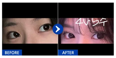 [Gangnam Unni] Phẫu thuật mắt / Sau 1 tháng / Biệt danh: Trà sữa bạc hà socola