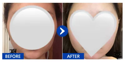 [Gangnam Unni] Phẫu thuật gọt mặt / Tháng thứ 1 / Biệt danh: daldal2