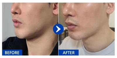 [Babitalk] Hút mỡ mặt / Tháng thứ 2 / Biệt danh: Gum-bung-eo