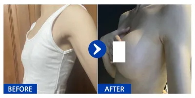 [Gangnam Unni] Nâng ngực (Motiva) / 1 tháng / Biệt danh: Thảo mộc xanh