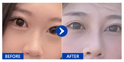 [Gangnam Unni] Phẫu thuật nâng mũi / Tháng thứ 2 / Biệt danh: Ongchu