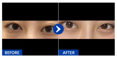 [Gangnam Unni] Tái định vị mỡ mắt, cắt mí dưới / 1 tháng / Biệt danh: Nan-dot-gyu