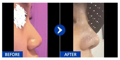 [Gangnam Unni] Mũi / Tháng thứ 1 / Biệt danh: kirakira.s