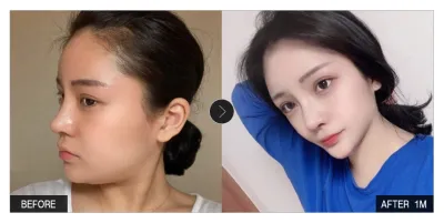 [Review Gangnam Unni] Hút mỡ mặt tròn một tháng / Biệt danh: Som-sa-tang Mo-gu