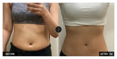 [Review Gangnam Unni] Hút mỡ tháng thứ 1 / Biệt danh: Somsatang Mogu