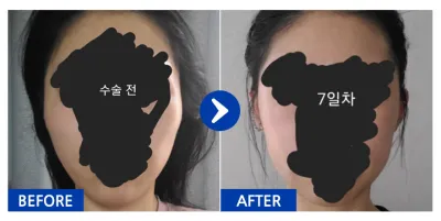 [Gangnam Unni] Gò má / Tháng thứ 1 / Biệt danh: Thịt vì thịt