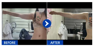 [Babitalk] Hút mỡ / Tháng thứ 1 / Biệt danh: Thỏ điên