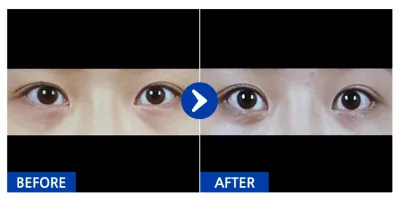 [Babitalk] Mở góc mắt kép, tái sắp xếp mỡ mắt / 1 tháng / Biệt danh: 냐아아아에에용