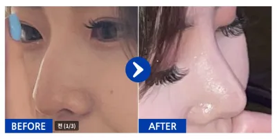 [Gangnam Unni] Phẫu thuật thẩm mỹ mũi / 1 tháng / Biệt danh: skfk2299