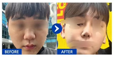 [Gangnam Unni] Phẫu thuật nâng mũi / Tháng thứ 2 / Biệt danh: Mũi là nỗi lo của mình