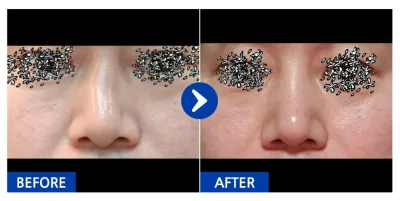 [Babytalk] Phẫu thuật mũi / 1 tháng / Biệt danh: Superchu