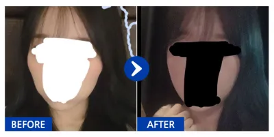 [Gangnam Unni] Gò má / 1 tháng / Biệt danh: Lỗi tại mắt không đều;