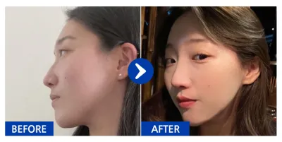 [Babitalk] Nâng mũi / Sau 1 năm / Biệt danh: atmospe