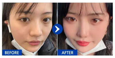 [Gangnam Unni] Tái định vị mỡ mí dưới / Tháng thứ 6 / Biệt danh: Ước mơ tương lai là mỹ nhân Gangnam