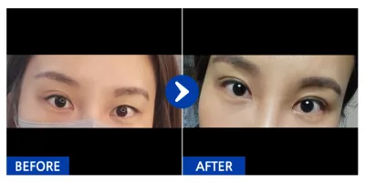 [Gangnam Unni] Nhấn mí tự nhiên (mí mắt) / Tuần 2 / Biệt danh: Dalbeong-ing