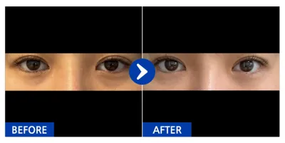 [Gangnam Unni] Tái định vị mỡ dưới mắt / Sau 1 tháng / Biệt danh: OooO와