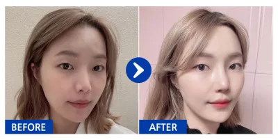 [Gangnam Unni] Phẫu thuật lại mũi / Tháng thứ 1 / Biệt danh: ohnee5