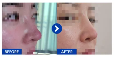 [Babitalk] Phẫu thuật lại mũi / Tháng thứ 1 / Biệt danh: Koalachichi