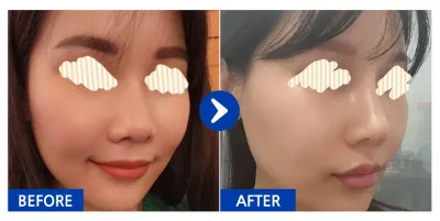 [Babitalk] Phẫu thuật lại mũi / Tháng thứ 1 / Biệt danh: wane