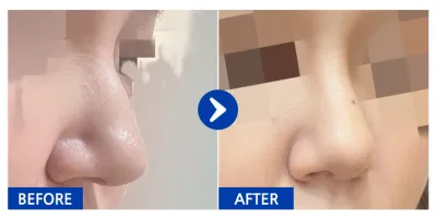 [Gangnam Unni] Phẫu thuật lại mũi / Tháng thứ 1 / Biệt danh: jjjejjj