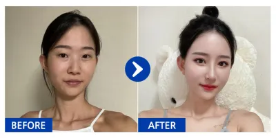 [Gangnam Unni] Phẫu thuật lại mắt, tái định vị mỡ dưới mắt, mũi, tạo hình khuôn mặt 2 vùng (gò má, hàm vuông), ngực (Motiva), cấy mỡ (trán, má trước) / 1 tháng / Biệt danh: Dyududyudyu