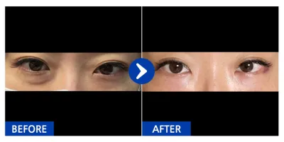 [Babitalk] Tái cấu trúc mỡ mí dưới / Tháng thứ 1 / Biệt danh: yoouii