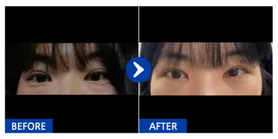 [Gangnam Unni] Tái định vị mỡ mí mắt dưới / 1 tháng / Biệt danh: Kim ㅇ Hyun