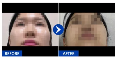 [Gangnam Unni] Phẫu thuật gọt mặt (gò má) / Tuần thứ 3 / Biệt danh: beami