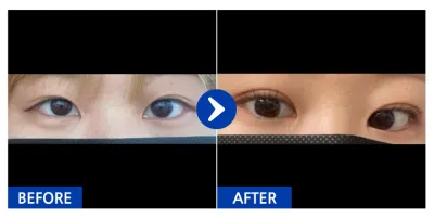 [Babitalk] Nhấn mí tự nhiên (mí mắt) / Tháng thứ 1 / Biệt danh: Người đẹp Dangsan