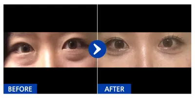 [Gangnam Unni] Tái định vị mỡ dưới mắt / Tháng thứ 1 / Biệt danh: Sseu-ing