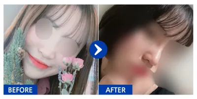 [Gangnam Unni] Nâng mũi tháng thứ 1 / Biệt danh: v1nnn