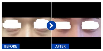 [Gangnam Unni] Tái phân bố mỡ mí dưới tháng thứ 1 / Biệt danh: iil1ili