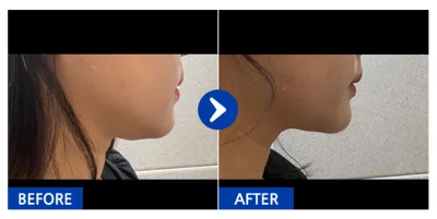 [Gangnam Unni] Hút mỡ mặt tháng thứ 1 / Biệt danh: mj_park