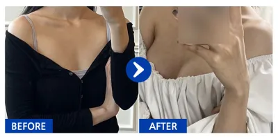 [Babitalk] Phẫu thuật nâng ngực Mentor tháng thứ 1 / Biệt danh: Han Sol Sol Ba Ram