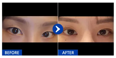 [Gangnam Unni] Nhấn mí tự nhiên (mí đôi) tháng thứ 1 / Biệt danh: Killer Trainee