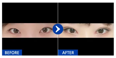 [Gangnam Unni] Nhấn mí tự nhiên, mở góc mắt trong, chỉnh hình dáng mắt tháng thứ 1 / Biệt danh: Pohahangpuhahang