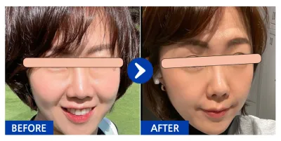 [Gangnam Unni] Tái định vị mỡ mí mắt dưới tháng thứ 1 / Biệt danh: Cherry Kong 7