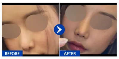 [Gangnam Unni] Tái phẫu thuật mũi tháng thứ 1 / Biệt danh: huisll_day